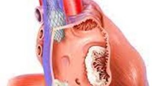 TricValve 1