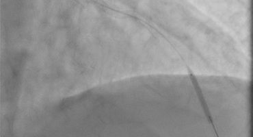 Coronary stent loss in a heavily calcified lesion