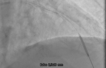 Coronary stent loss in a heavily calcified lesion