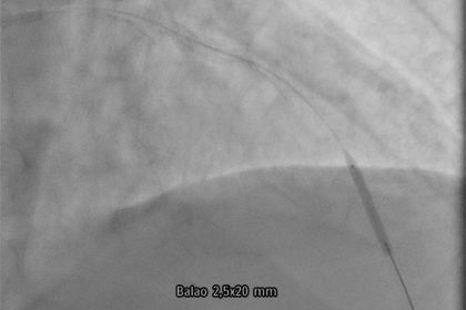Coronary stent loss in a heavily calcified lesion