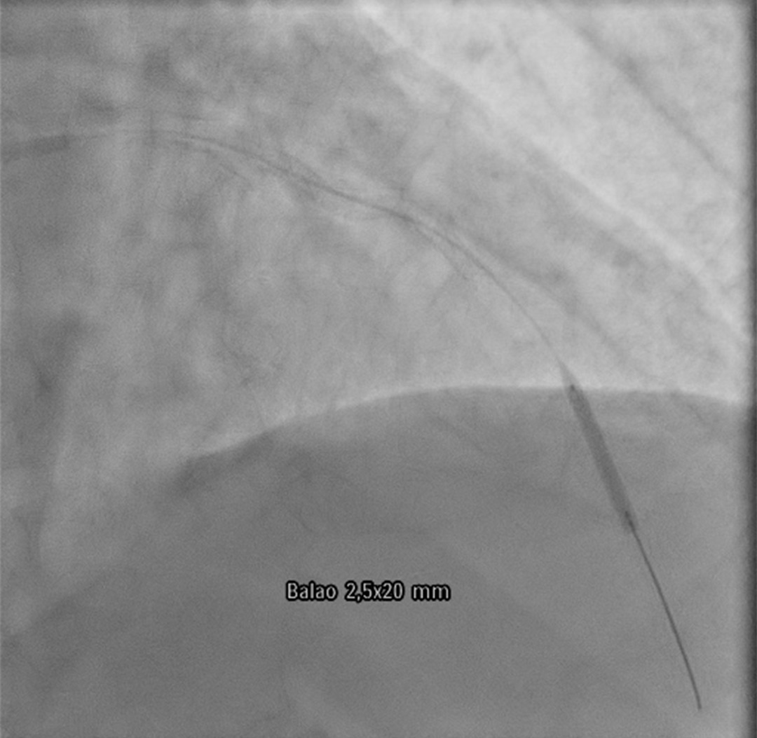 Coronary stent loss in a heavily calcified lesion Coronary stent loss in a heavily calcified lesion